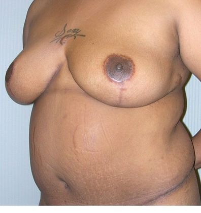 After Image: Mommy Makeover: Case 7 - left-front-oblique