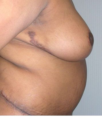 After Image: Mommy Makeover: Case 7 - right-side