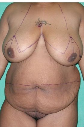 Before Image: Mommy Makeover: Case 7 - front
