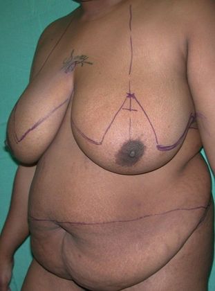 Before Image: Mommy Makeover: Case 7 - left-front-oblique