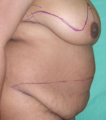 Before Image: Mommy Makeover: Case 7 - right-side