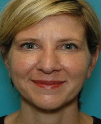 After Image: Eye Lift (Blepharoplasty): Case 7 - front