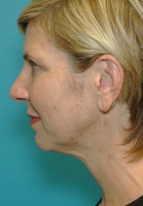 After Image: Eye Lift (Blepharoplasty): Case 7 - left-side