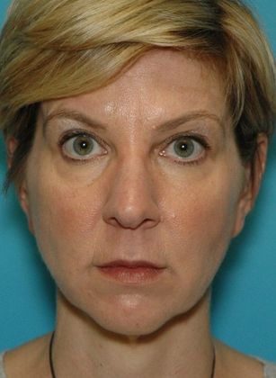 Before Image: Eye Lift (Blepharoplasty): Case 7 - front