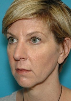 Before Image: Eye Lift (Blepharoplasty): Case 7 - left-front-oblique