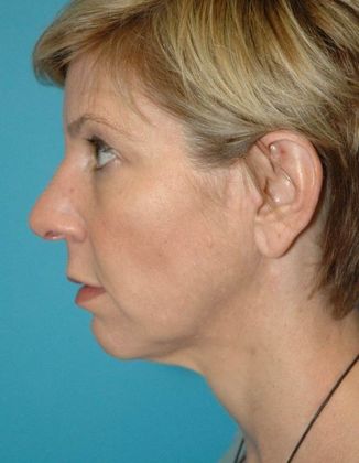 Before Image: Eye Lift (Blepharoplasty): Case 7 - left-side