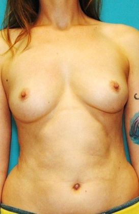 Before Image: Breast Augmentation: Case 7 - front