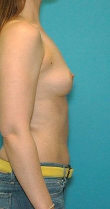 Before Image: Breast Augmentation: Case 7 - right-side