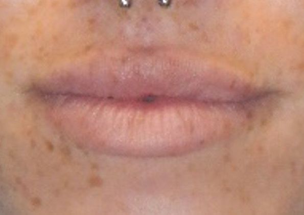 After Image: Soft Tissue Fillers: Case 7 - front