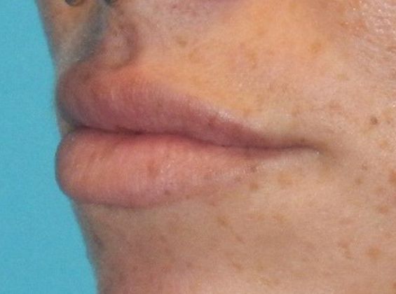 After Image: Soft Tissue Fillers: Case 7 - left-front-oblique