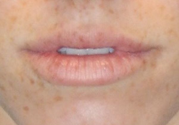 Before Image: Soft Tissue Fillers: Case 7 - front