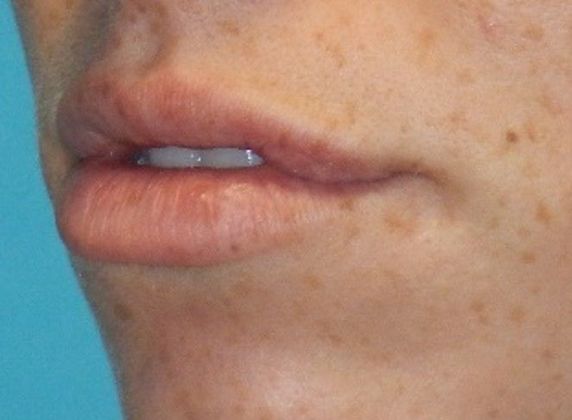 Before Image: Soft Tissue Fillers: Case 7 - left-front-oblique