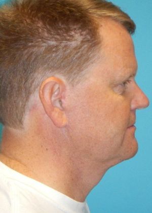 After Image: Neck Lift: Case 7 - right-side