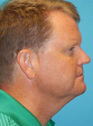 Before Image: Neck Lift: Case 7 - right-side