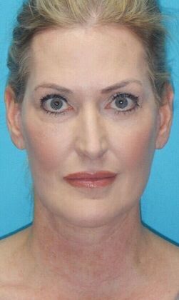 After Image: Fat Grafting Face: Case 7 - front