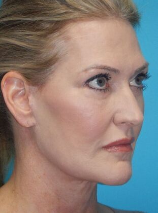 After Image: Fat Grafting Face: Case 7 - right-front-oblique