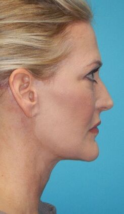 After Image: Fat Grafting Face: Case 7 - right-side