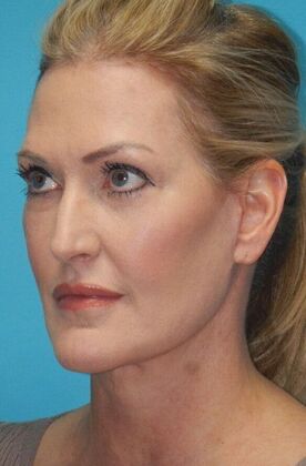 After Image: Fat Grafting Face: Case 7 - left-front-oblique