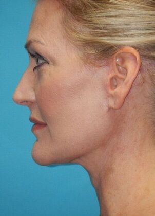 After Image: Fat Grafting Face: Case 7 - left-side