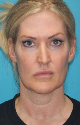 Before Image: Fat Grafting Face: Case 7 - front