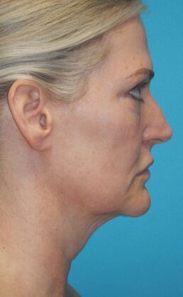 Before Image: Fat Grafting Face: Case 7 - right-side
