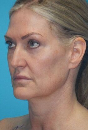 Before Image: Fat Grafting Face: Case 7 - left-front-oblique