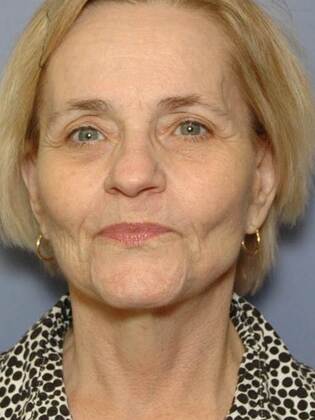 After Image: Face & Neck Lifts: Case 8 - front