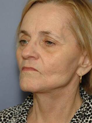 After Image: Face & Neck Lifts: Case 8 - left-front-oblique