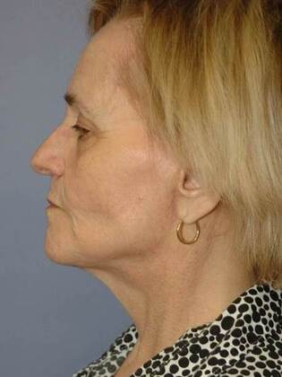 After Image: Face & Neck Lifts: Case 8 - left-side
