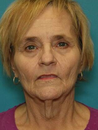 Before Image: Face & Neck Lifts: Case 8 - front