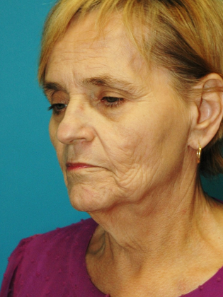 Before Image: Face & Neck Lifts: Case 8 - left-front-oblique