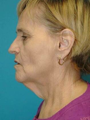 Before Image: Face & Neck Lifts: Case 8 - left-side