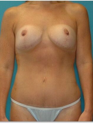 After Image: Abdominoplasty: Case 8 - front