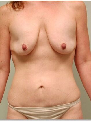 Before Image: Abdominoplasty: Case 8 - front