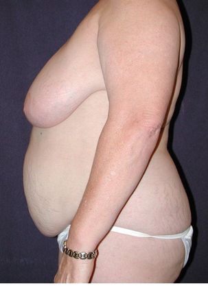 Before Image: Breast Reduction: Case 8 - left-side