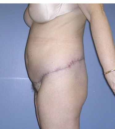 After Image: Body Lifts: Case 8 - left-side