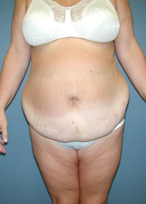 Before Image: Body Lifts: Case 8 - front
