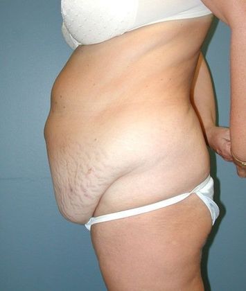 Before Image: Body Lifts: Case 8 - left-side
