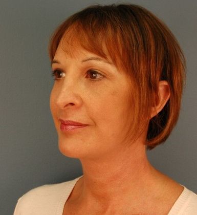 After Image: Mini Facelift: Case 8 - left-front-oblique