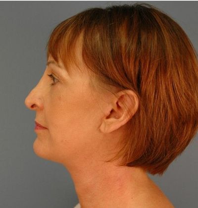 After Image: Mini Facelift: Case 8 - left-side