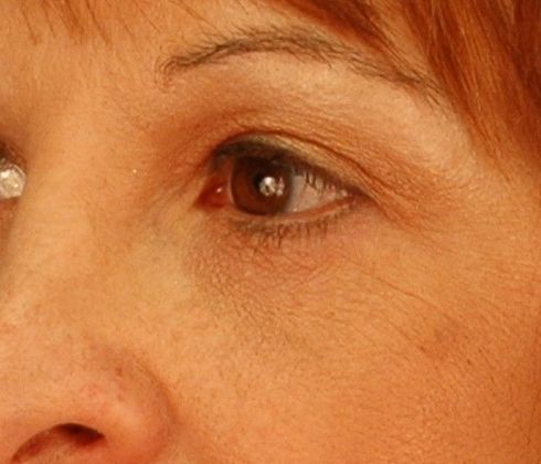 After Image: Mini Facelift: Case 8 - left-front-oblique