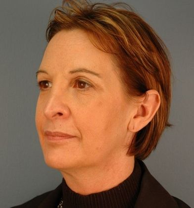 Before Image: Mini Facelift: Case 8 - left-front-oblique