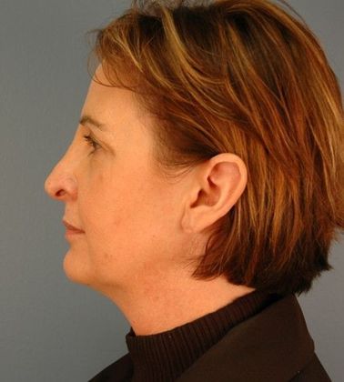 Before Image: Mini Facelift: Case 8 - left-side