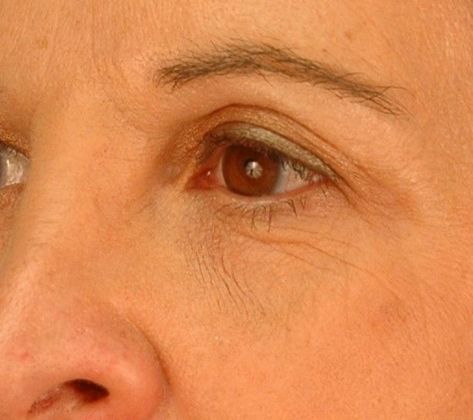 Before Image: Mini Facelift: Case 8 - left-front-oblique