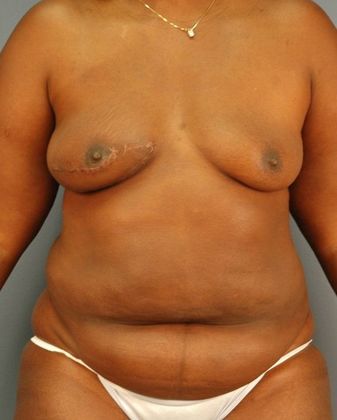 After Image: Breast Reconstruction: Case 8 - front