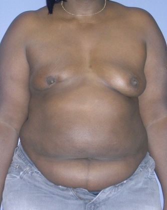 Before Image: Breast Reconstruction: Case 8 - front