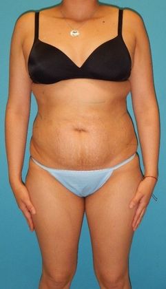 After Image: Brazilian Butt Lift: Case 8 - front