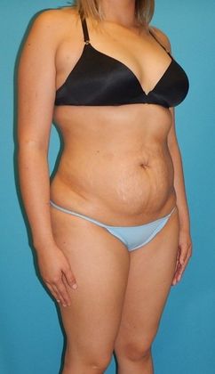 After Image: Brazilian Butt Lift: Case 8 - right-front-oblique