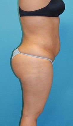 After Image: Brazilian Butt Lift: Case 8 - right-side