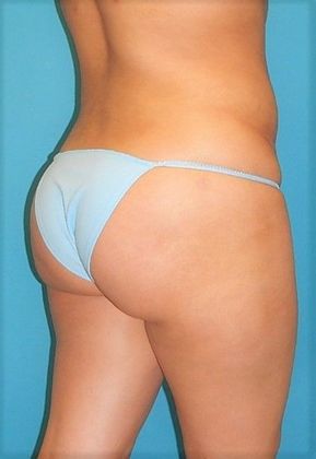 After Image: Brazilian Butt Lift: Case 8 - right-back-oblique